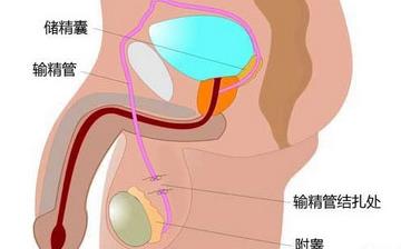 【男性结扎】男性结扎手术_结扎手术对男性的影响_男性结扎注意什么